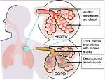 How Does Copd Affect Co2