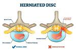 How Does Disc Herniations Happen?
