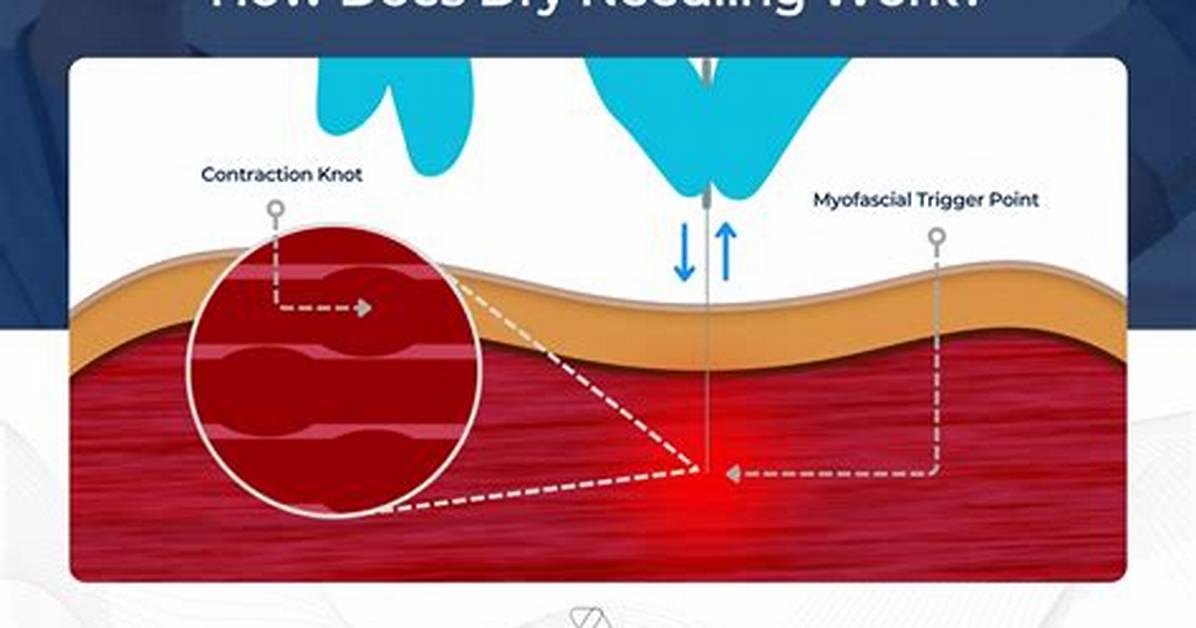 How Does Dry Needling Work