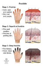 How Does Frostbite Work?