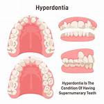 How Does Hyperdontia Happen?