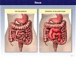 How Does Ileus Happen?