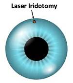 How Does Iridotomy Work?