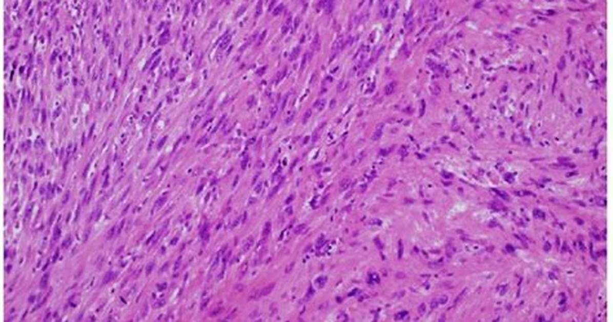 How Does Leiomyosarcoma Present?