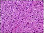 How Does Leiomyosarcoma Present?