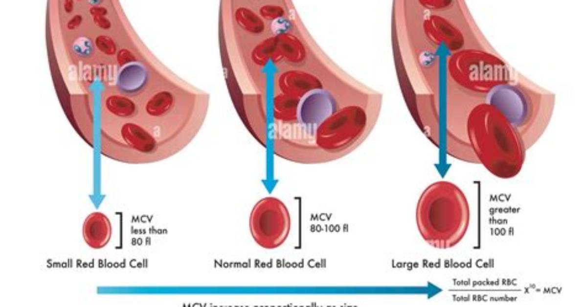 How Does Macrocytosis Work?