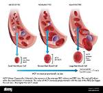How Does Macrocytosis Work?