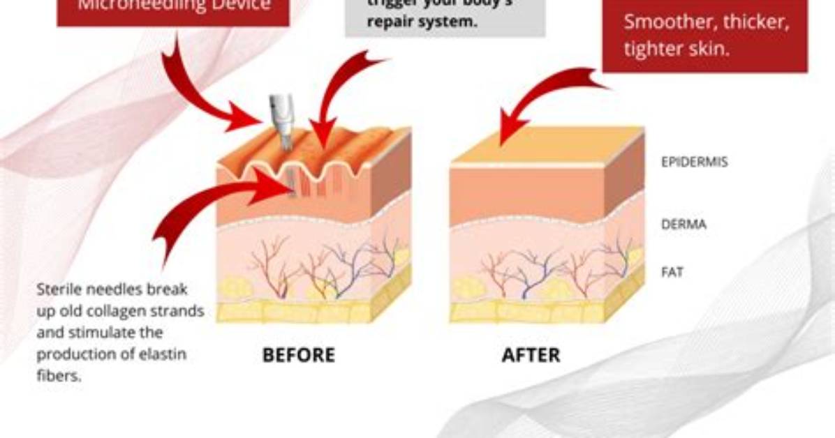 How Does Micro Needling Work?