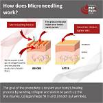 How Does Micro Needling Work?