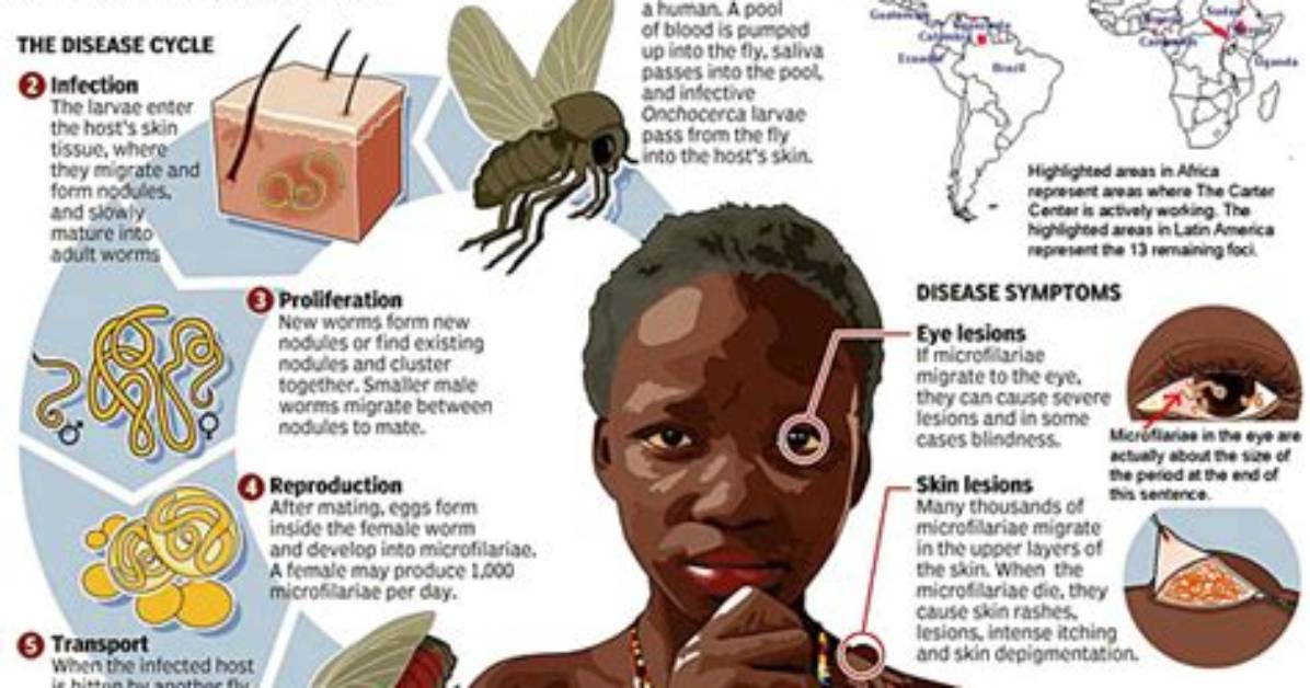 How Does Onchocerca Cause Blindness?