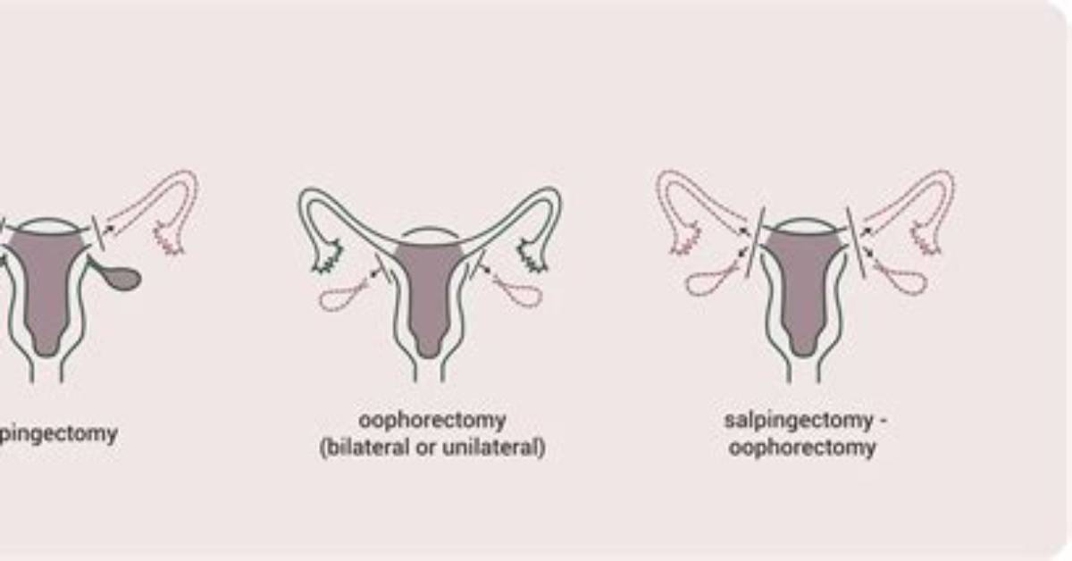 How Does Oophorectomy Work?