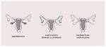 How Does Oophorectomy Work?