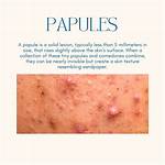How Does Papules Look Like?