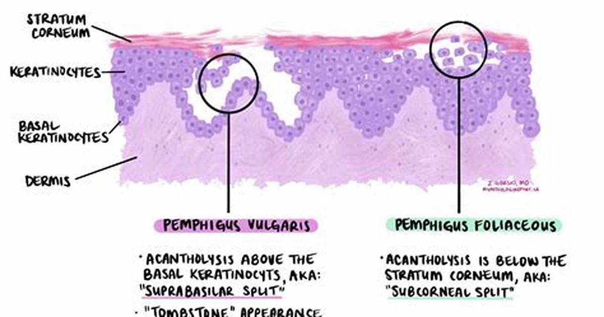 How Does Pemphigus Start?