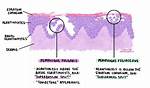 How Does Pemphigus Start?