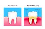 How Does Plaque Look Like?