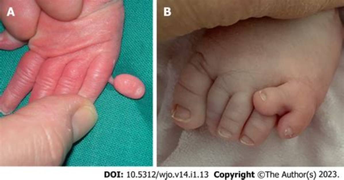 How Does Polydactyly Occur?