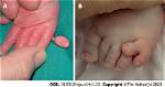 How Does Polydactyly Occur?