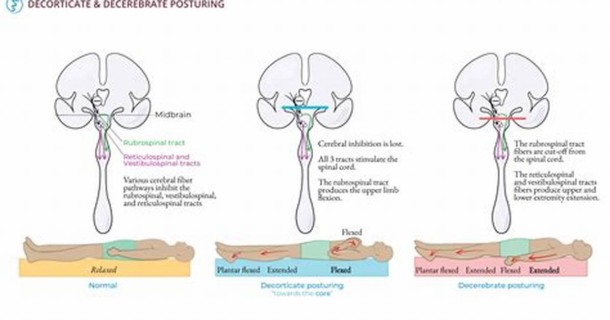 How Does Posturing Occur?