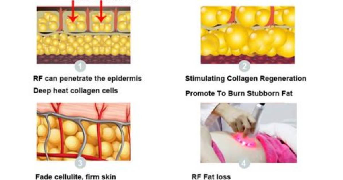 How Does Radiofrequency Work?