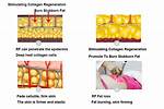 How Does Radiofrequency Work?