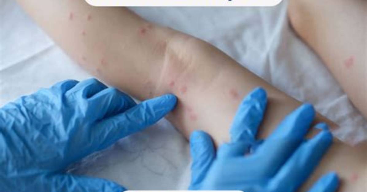 How Does Smallpox Cause Death?