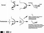 How Does Thalidomide Causes Phocomelia?