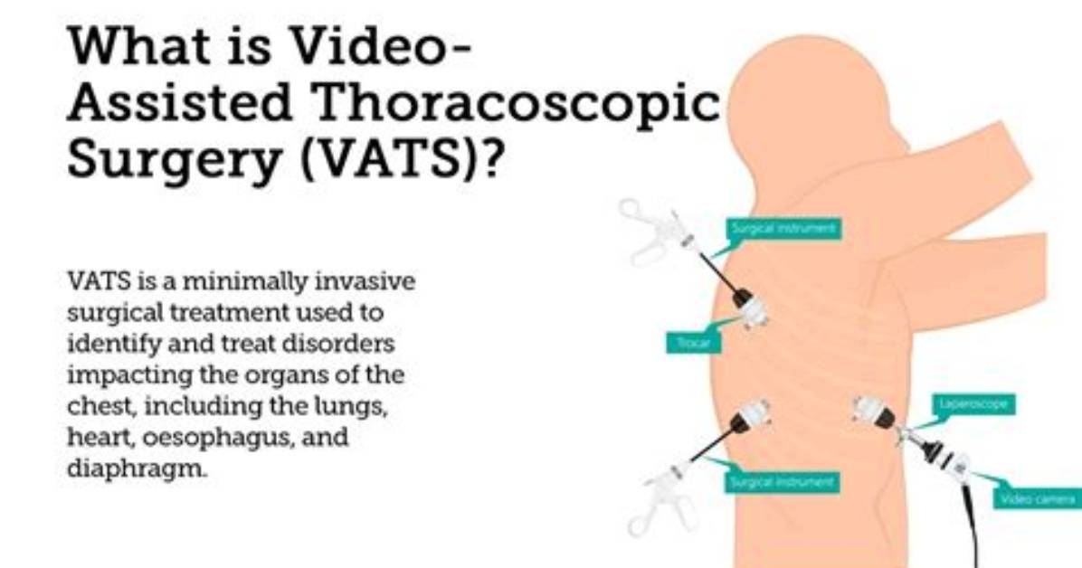 How Does the Vats System Work?