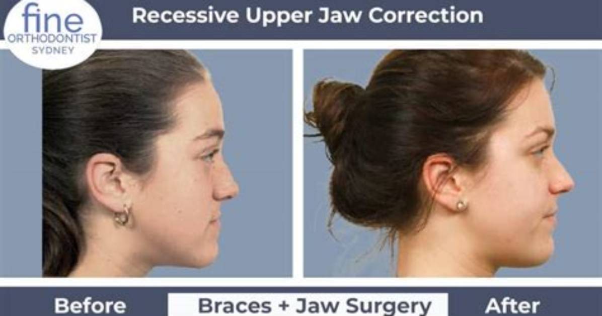 How Does Underbite Surgery Work?