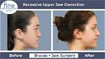 How Does Underbite Surgery Work?