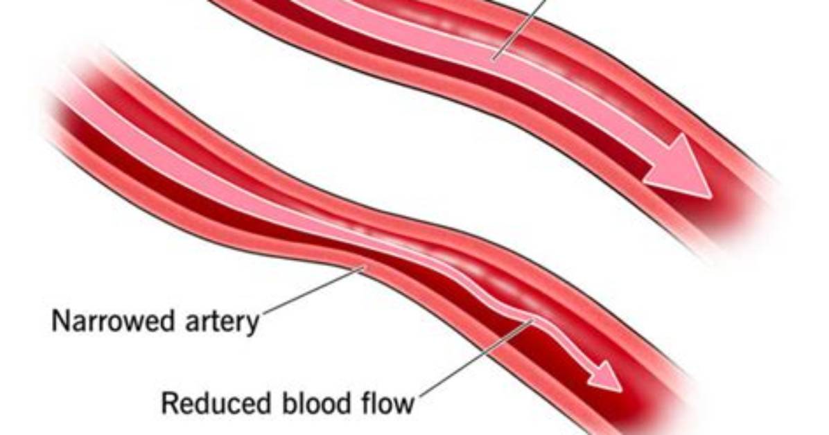 How Does Vasospasm Occur?