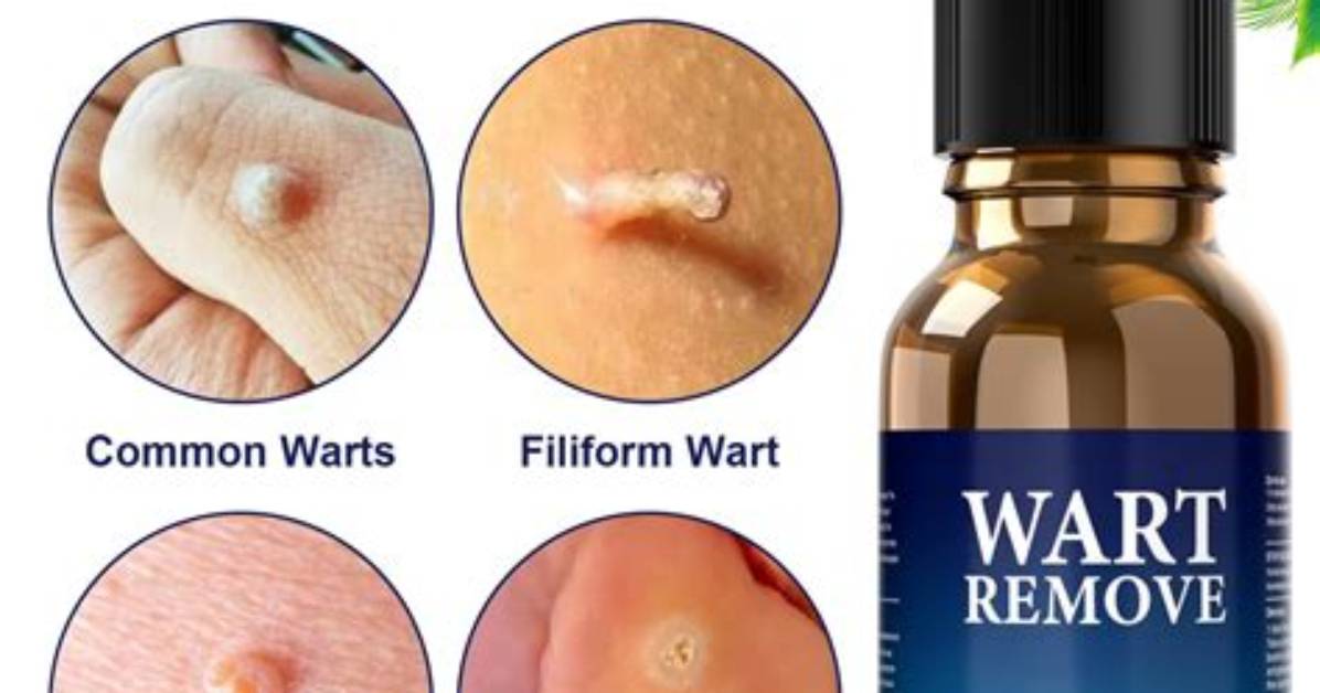 How Does Wart Remover Work?