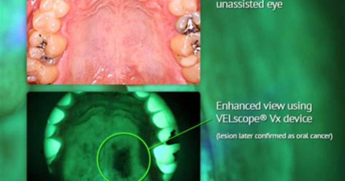 How Effective Is Velscope