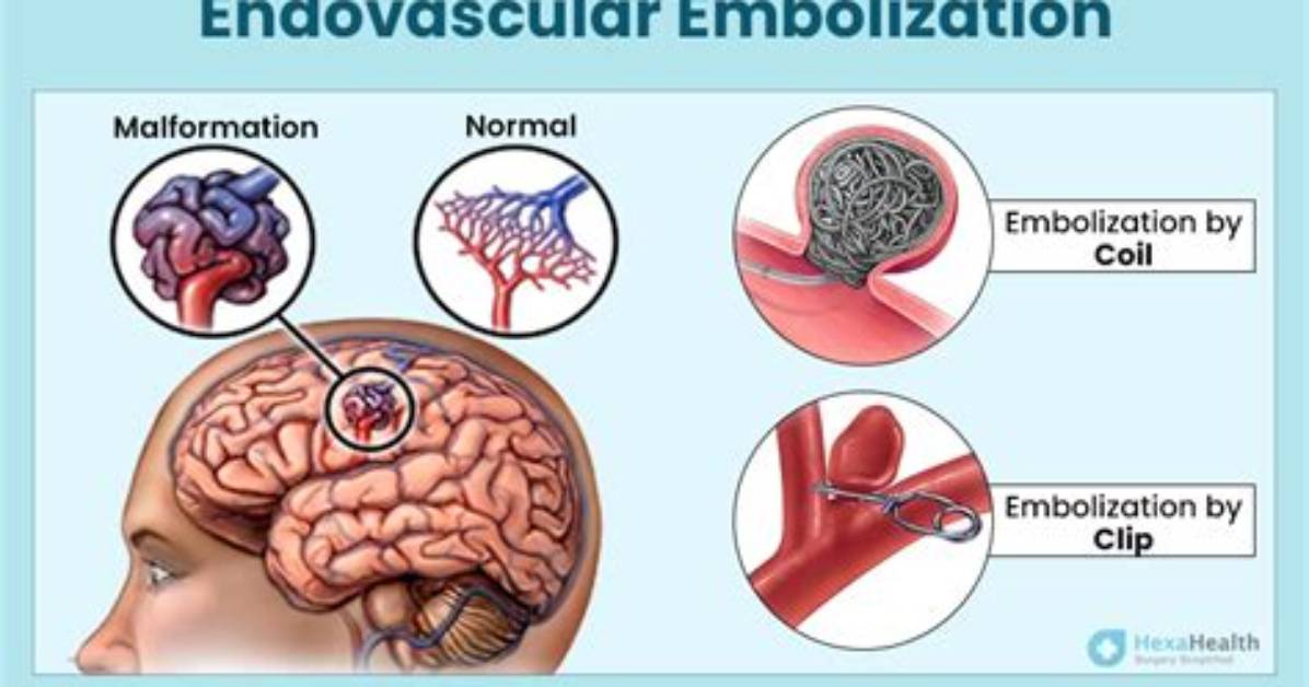 How Embolization Is Done?