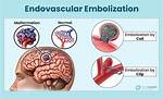 How Embolization Is Done?