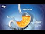 How Fast Do Tums Work