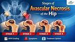 How Fast Does Avascular Necrosis Progress?