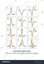 How Is Ecg Generated