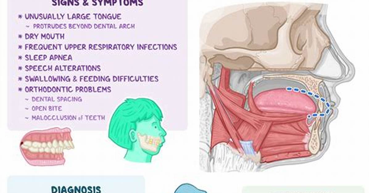 How Is Macroglossia Causes?