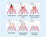 How Long Do Root Canals Take?