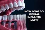 How Long Do Teeth Jackets Last