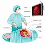 How Long Does a Laparoscopy Take?