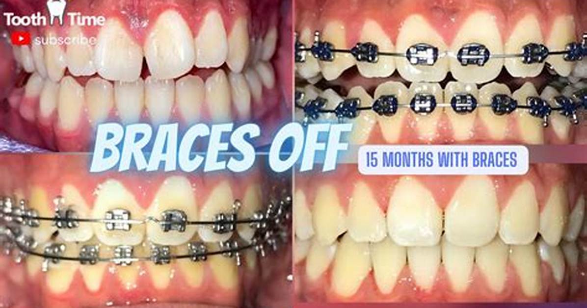 How Long Does Brace Fitting Take?