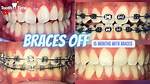 How Long Does Brace Fitting Take?
