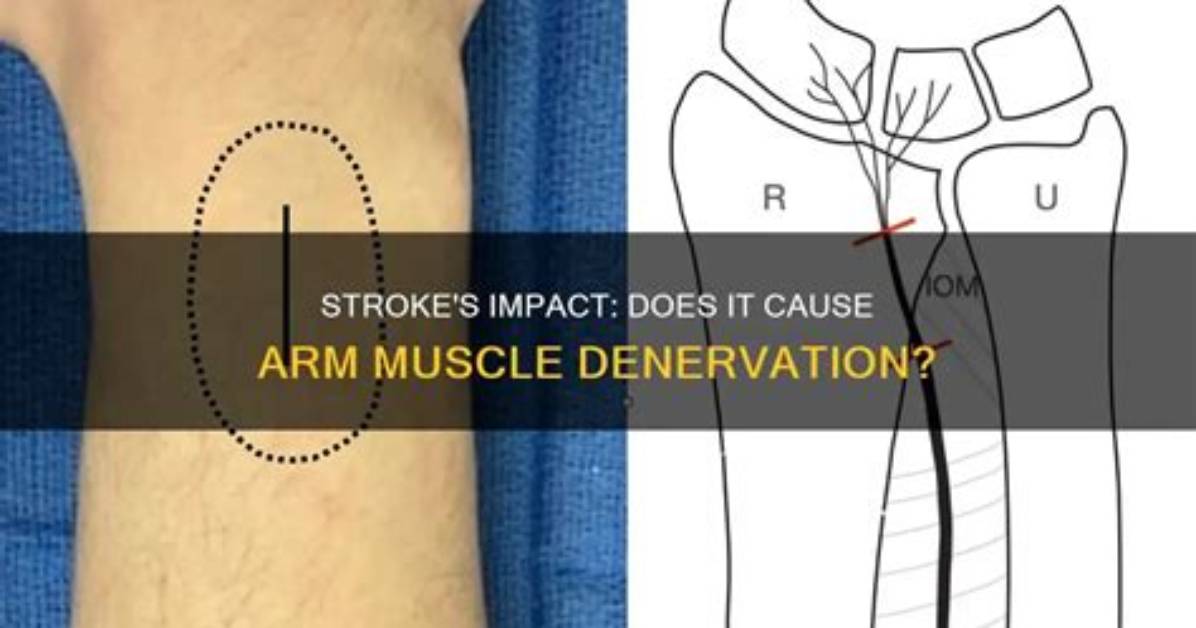 How Long Does Denervation Last?