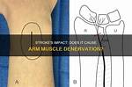 How Long Does Denervation Last?