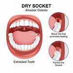How Long Does Dry Socket Last