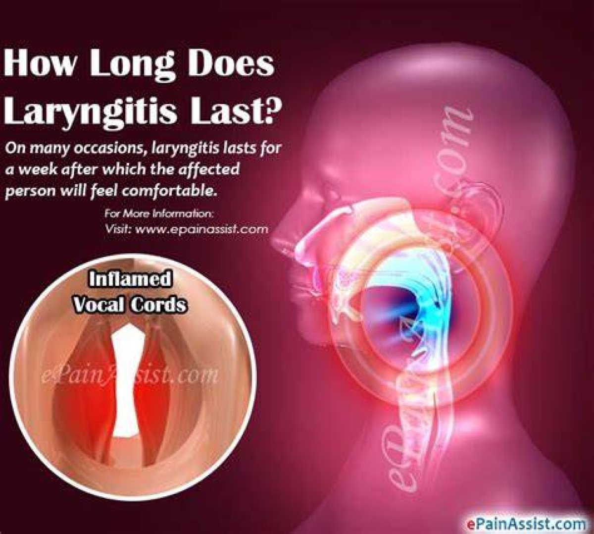 How Long Does Laryngitis Last?