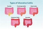 How Long Does Proctitis Last?