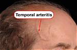 How Long Does Temporal Arteritis Last